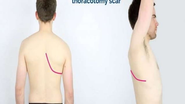 Decortication of the lung.pptx