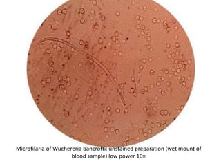 Microfilaria of Wuchereria bancrofti: unstained preparation (wet mount of
blood sample) low power 10×
 