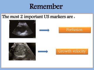 Remember
The most 2 important US markers are :
Perfusion
Growth velocity
 