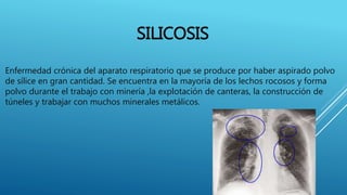 SILICOSIS
Enfermedad crónica del aparato respiratorio que se produce por haber aspirado polvo
de sílice en gran cantidad. Se encuentra en la mayoría de los lechos rocosos y forma
polvo durante el trabajo con minería ,la explotación de canteras, la construcción de
túneles y trabajar con muchos minerales metálicos.
 