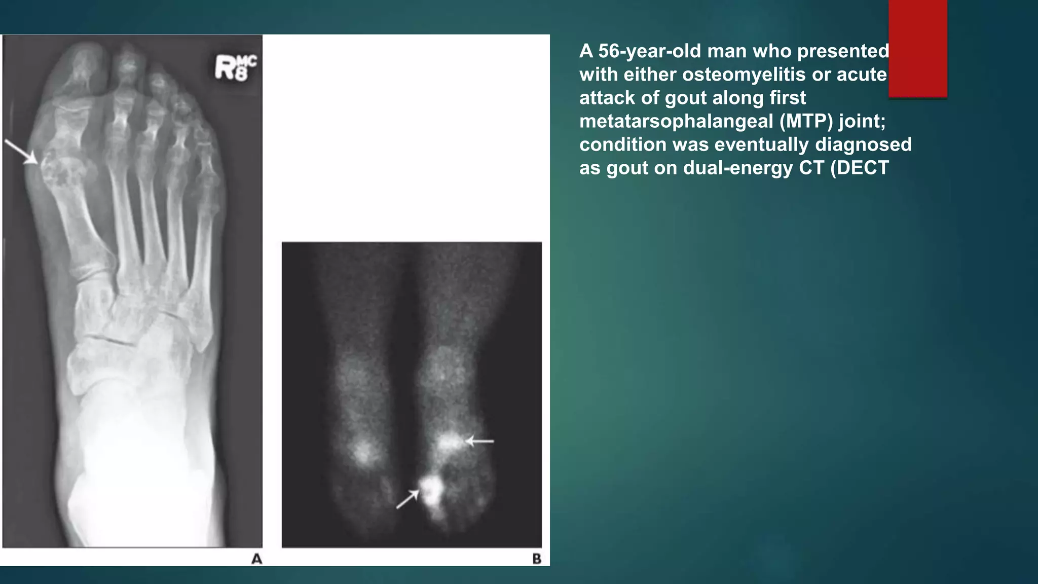 APPLICATION OF DUAL ENERGY CT IN EMERGENCY RADIOLOGY | PPTX