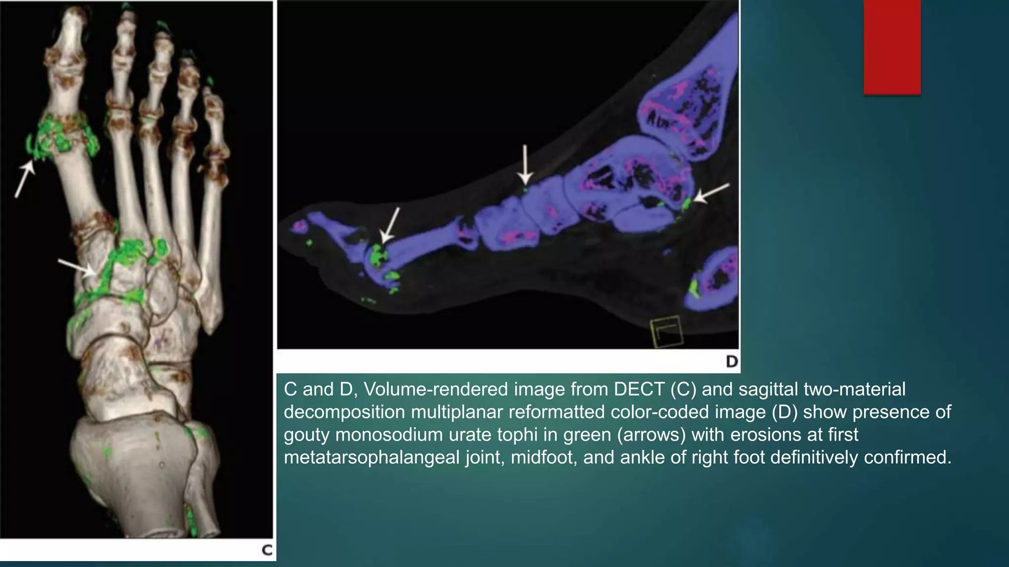 APPLICATION OF DUAL ENERGY CT IN EMERGENCY RADIOLOGY | PPTX