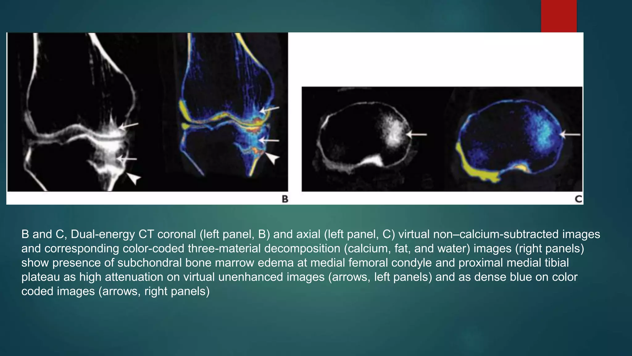 APPLICATION OF DUAL ENERGY CT IN EMERGENCY RADIOLOGY | PPTX