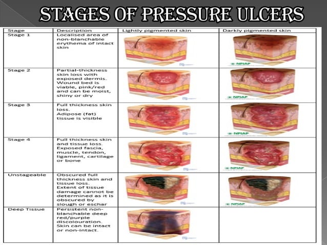 DECUBITUS ULCER.pdf | Skin and Dermatology | Diseases and Conditions