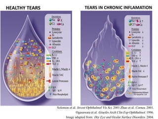 HEALTHY TEARS TEARS IN CHRONIC INFLAMATION
Solomon et al. Invest Ophthalmol Vis Sci. 2001.Zhao et al. Cornea. 2001.
Ogasawara et al. Graefes Arch Clin Exp Ophthalmol. 1996.
Image adapted from: Dry Eye and Ocular Surface Disorders. 2004.
 