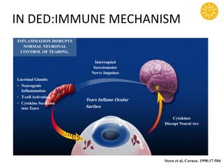 IN DED:IMMUNE MECHANISM
INFLAMMATION DISRUPTS
NORMAL NEURONAL
CONTROL OF TEARING.
Lacrimal Glands:
• Neurogenic
Inflammation
• T-cell Activation
• Cytokine Secretion
into Tears
Interrupted
Secretomotor
Nerve Impulses
Tears Inflame Ocular
Surface
Cytokines
Disrupt Neural Arc
Stern et al, Cornea. 1998:17:584
 