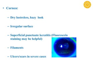 • Cornea:
– Dry lustreless, hazy look
– Irregular surface
– Superficial punctuate keratitis (Fluorescein
staining may be helpful)
– Filaments
– Ulcers/scars in severe cases
 