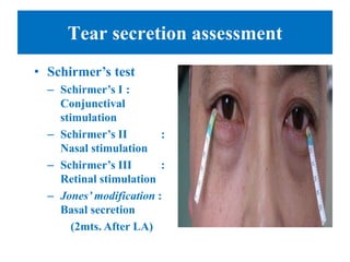 Tear secretion assessment
• Schirmer’s test
– Schirmer’s I :
Conjunctival
stimulation
– Schirmer’s II :
Nasal stimulation
– Schirmer’s III :
Retinal stimulation
– Jones’ modification :
Basal secretion
(2mts. After LA)
 