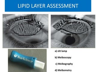 LIPID LAYER ASSESSMENT
a) slit lamp
b) Meiboscopy
c) Meibography
d) Meibometry
 