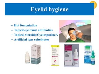 Eyelid hygiene
– Hot fomentation
– Topical/systemic antibiotics
– Topical steroids/CyclosporineA
– Artificial tear substitutes
 
