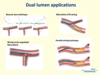 Cto Dual Injection Dedicated CTO kit: microcatheters, balloons, adjunctive devices | PPTX