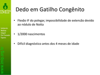 Dedo em Gatilho Congênito
• Flexão IF do polegar, impossibilidade de extensão devido
ao nódulo de Notta
• 1/2000 nascimentos
• Difícil diagnóstico antes dos 4 meses de idade
 