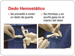 Dedo Hemostático
 Se procedió a cortar

un dedo de guante

 Se introdujo y se

acuñó gasa en el
interior del dedo

 