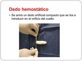 Dedo hemostático
 Se armó un dedo artificial compacto que se iba a

introducir en el orificio del cuello.

 