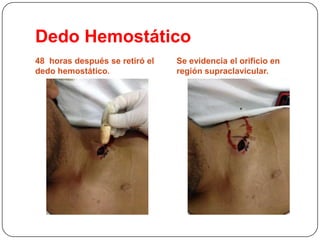 Dedo Hemostático
48 horas después se retiró el
dedo hemostático.

Se evidencia el orificio en
región supraclavicular.

 
