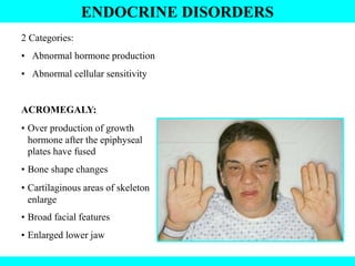 ENDOCRINE DISORDERS
2 Categories:
• Abnormal hormone production
• Abnormal cellular sensitivity
ACROMEGALY:
• Over production of growth
hormone after the epiphyseal
plates have fused
• Bone shape changes
• Cartilaginous areas of skeleton
enlarge
• Broad facial features
• Enlarged lower jaw
 