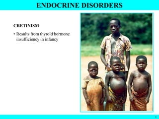 2
ENDOCRINE DISORDERS
CRETINISM
• Results from thyroid hormone
insufficiency in infancy
 