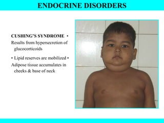 ENDOCRINE DISORDERS
CUSHING’S SYNDROME •
Results from hypersecretion of
glucocorticoids
• Lipid reserves are mobilized •
Adipose tissue accumulates in
cheeks & base of neck
 