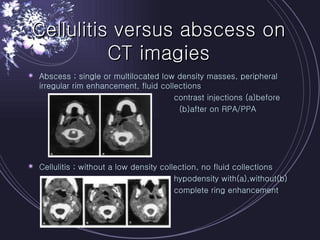 Cellulitis versus abscess on CT imagies Abscess ; single or multilocated low density masses, peripheral irregular rim enhancement, fluid collections contrast injections (a)before (b)after on RPA/PPA Cellulitis ; without a low density collection, no fluid collections hypodensity with(a),without(b) complete ring enhancement 
