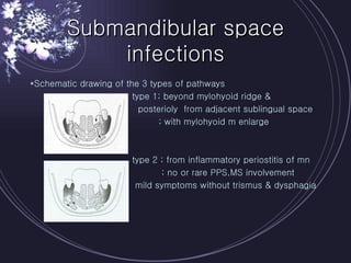 Submandibular space infections *Schematic drawing of the 3 types of pathways type 1; beyond mylohyoid ridge &  posterioly  from adjacent sublingual space ; with mylohyoid m enlarge type 2 ; from inflammatory periostitis of mn ; no or rare PPS,MS involvement mild symptoms without trismus & dysphagia 