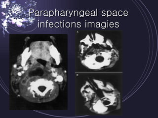 Parapharyngeal space infections imagies 