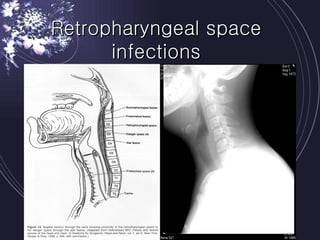 Retropharyngeal space infections 
