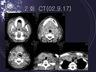 2회 CT(02.9.17) 