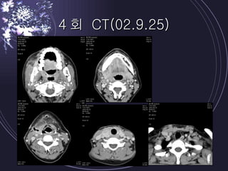 4회 CT(02.9.25) 