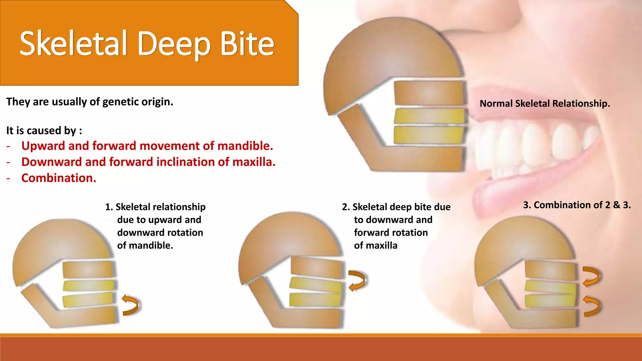 Deep Bite | PPTX