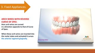 3. Fixed Appliances.
ARCH WIRES WITH REVERSE
CURVE OF SPEE:
Here arch wires are curved
in a direction opposite to that of Curve
of Spee.
When these arch wires are inserted into
the molar tubes and activated it curves
the anterior segment gingivally.
 