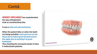 HERBST APPLIANCE has revolutionized
the way orthodontists
treat an overbite/deep bite.
It uses a tube and rod mechanism.
When the patient bites or when the teeth
are being occluded it puts pressure on the
lower jaw to help it grow forward and on
the upper jaw to assisting it to grow
backwards.
Thus checking the increased overjet in Class
II malocclusion patients.
Contd.
 