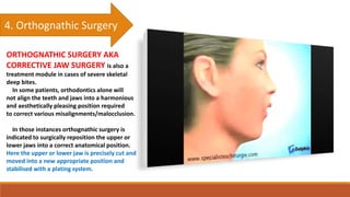 4. Orthognathic Surgery
ORTHOGNATHIC SURGERY AKA
CORRECTIVE JAW SURGERY is also a
treatment module in cases of severe skeletal
deep bites.
In some patients, orthodontics alone will
not align the teeth and jaws into a harmonious
and aesthetically pleasing position required
to correct various misalignments/malocclusion.
In those instances orthognathic surgery is
indicated to surgically reposition the upper or
lower jaws into a correct anatomical position.
Here the upper or lower jaw is precisely cut and
moved into a new appropriate position and
stabilised with a plating system.
 