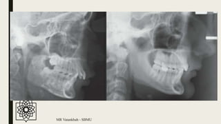 Deep bite | PPTX