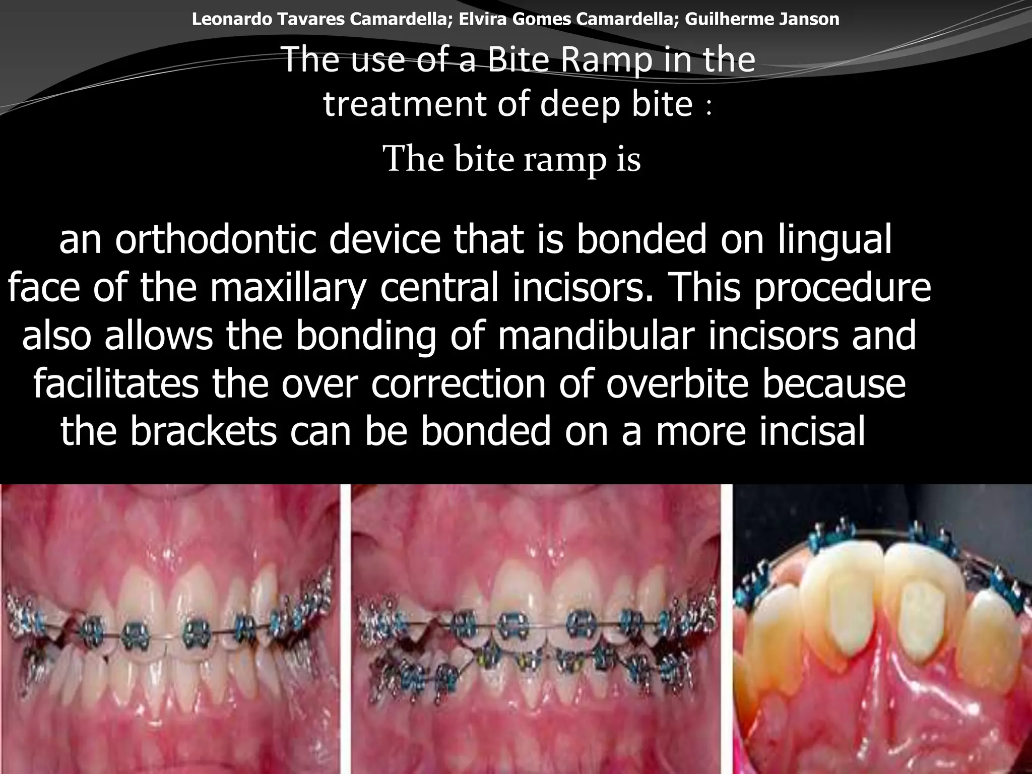 orthodontic deep bite | PPT