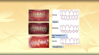 Deep bite.pptx over bite Deep bite.pptx over bite | PPTX