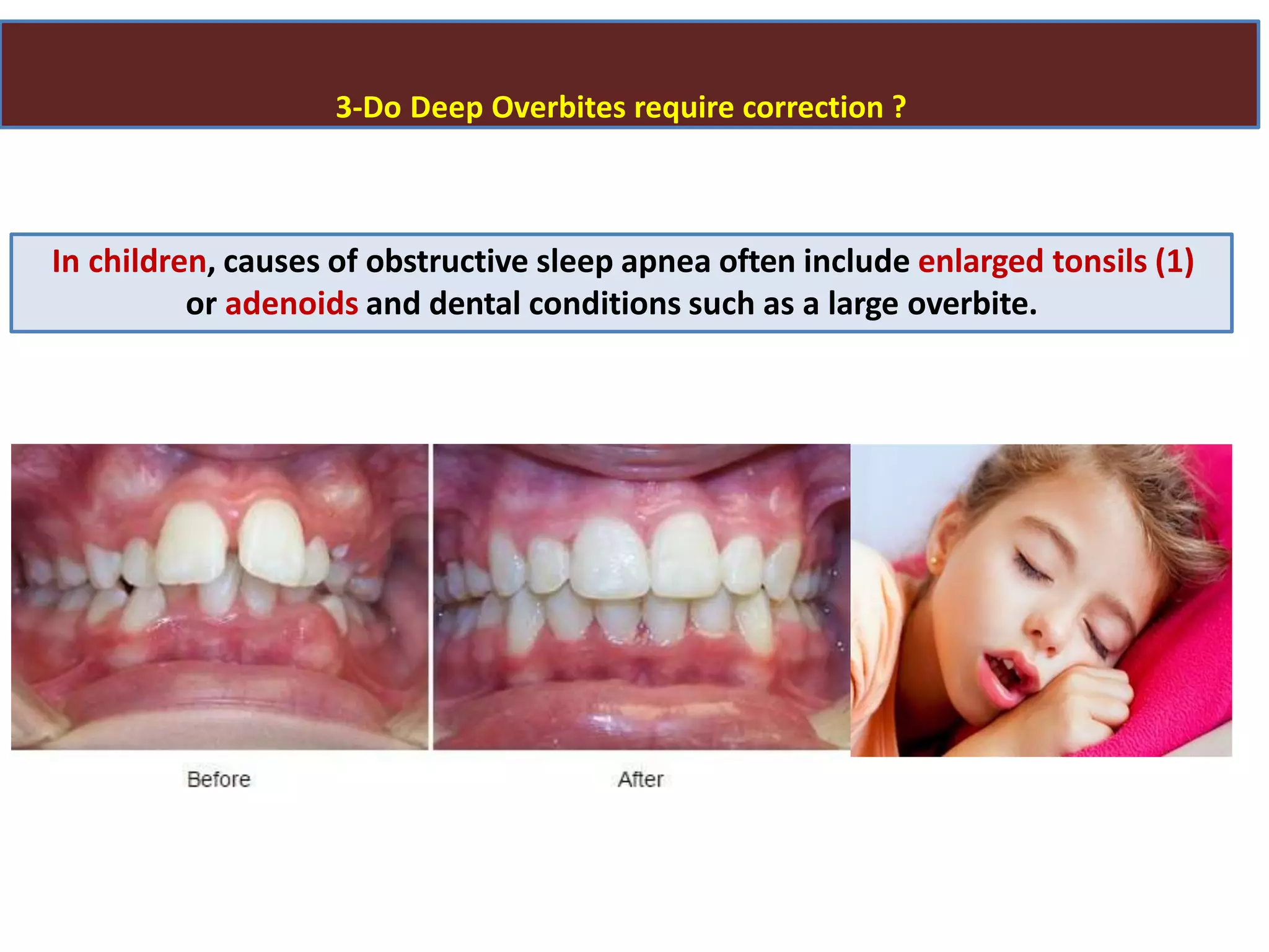3-Do Deep Overbites require correction ?
In children, causes of obstructive sleep apnea often include enlarged tonsils (1)
or adenoids and dental conditions such as a large overbite.
 