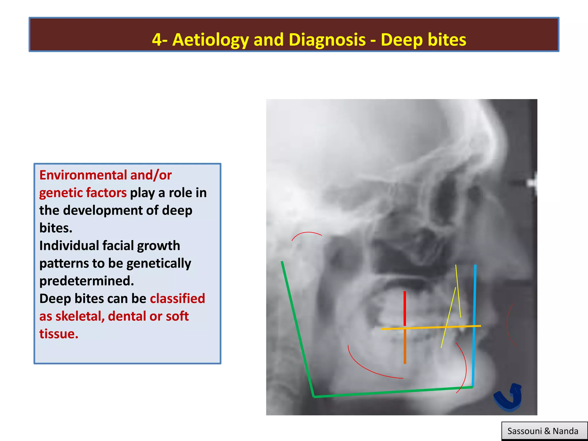 4- Aetiology and Diagnosis - Deep bites
Sassouni & Nanda
Environmental and/or
genetic factors play a role in
the development of deep
bites.
Individual facial growth
patterns to be genetically
predetermined.
Deep bites can be classified
as skeletal, dental or soft
tissue.
 