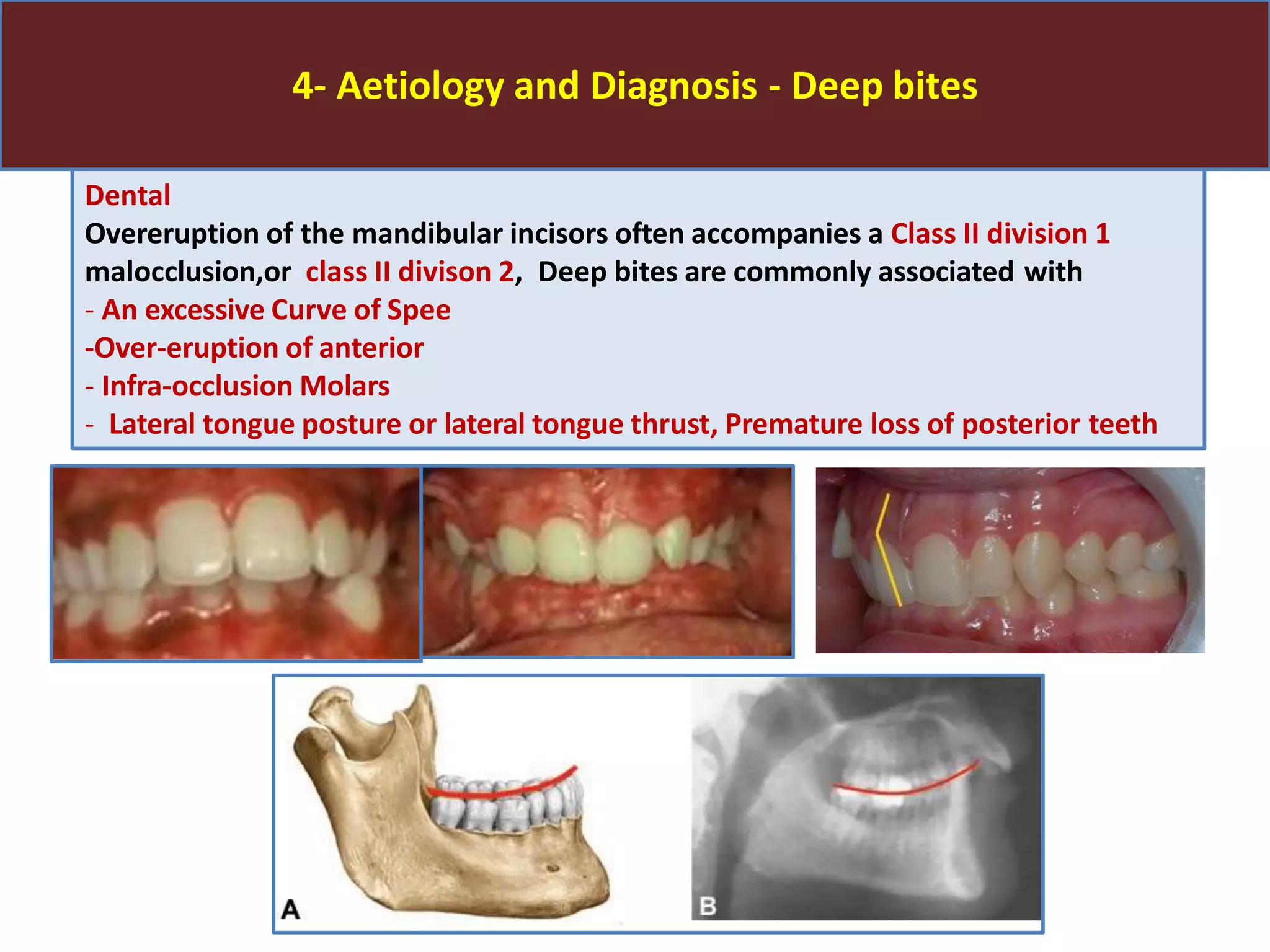 4- Aetiology and Diagnosis - Deep bites
Dental
Overeruption of the mandibular incisors often accompanies a Class II division 1
malocclusion,or class II divison 2, Deep bites are commonly associated with
- An excessive Curve of Spee
-Over-eruption of anterior
- Infra-occlusion Molars
- Lateral tongue posture or lateral tongue thrust, Premature loss of posterior teeth
 