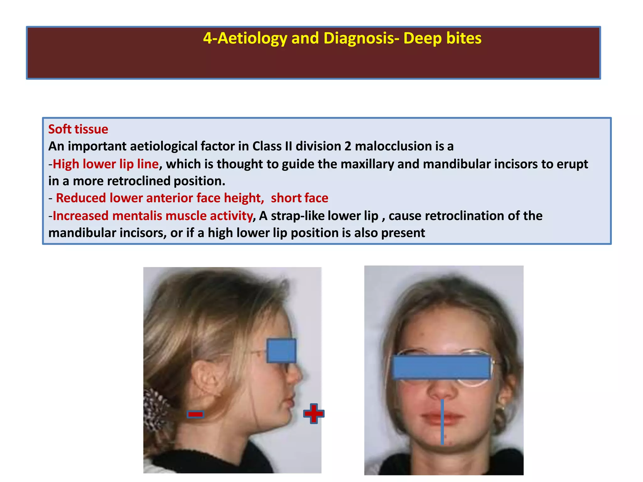 4-Aetiology and Diagnosis- Deep bites
Soft tissue
An important aetiological factor in Class II division 2 malocclusion is a
-High lower lip line, which is thought to guide the maxillary and mandibular incisors to erupt
in a more retroclined position.
- Reduced lower anterior face height, short face
-Increased mentalis muscle activity, A strap-like lower lip , cause retroclination of the
mandibular incisors, or if a high lower lip position is also present
 