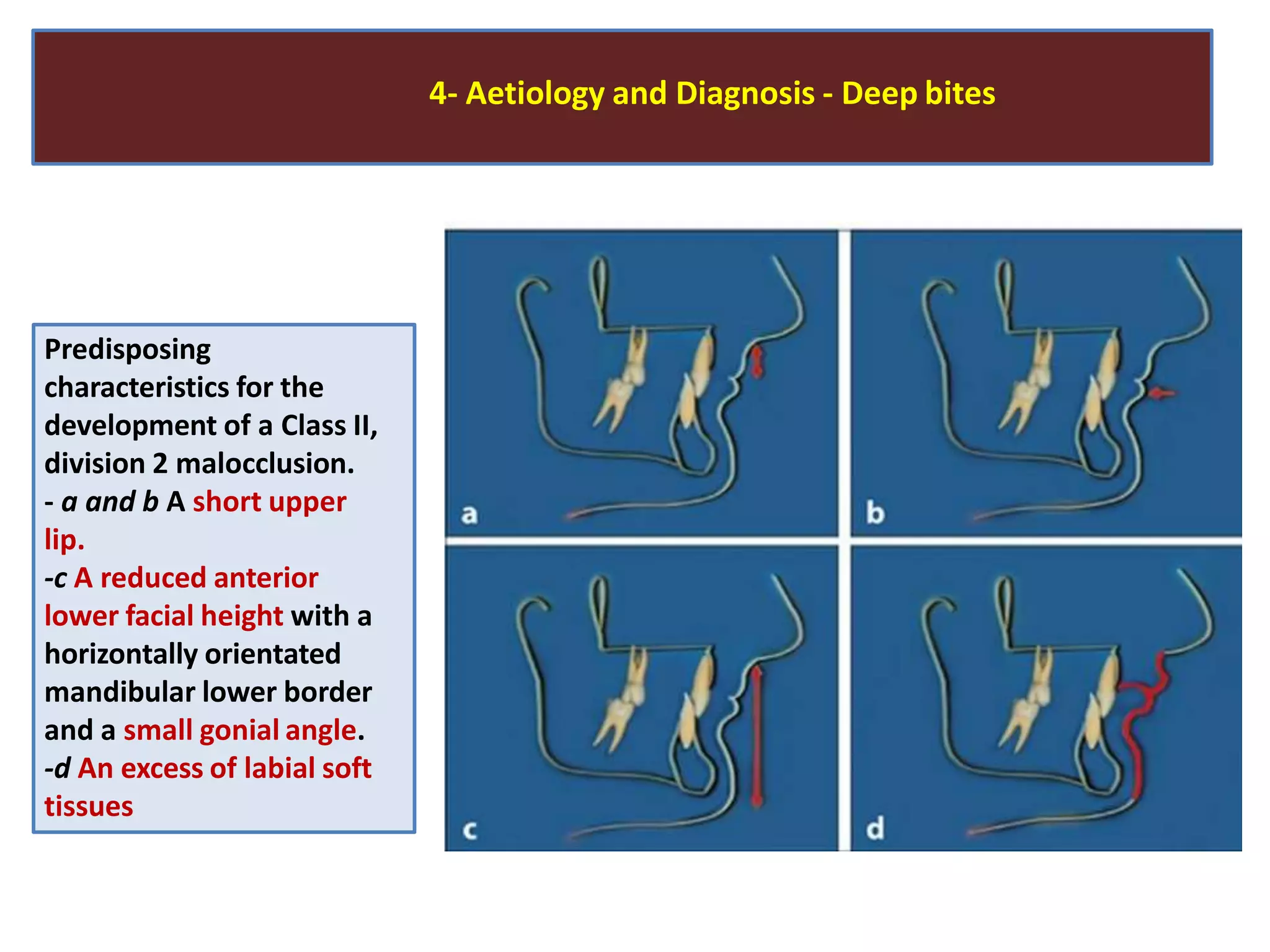 4- Aetiology and Diagnosis - Deep bites
Predisposing
characteristics for the
development of a Class II,
division 2 malocclusion.
- a and b A short upper
lip.
-c A reduced anterior
lower facial height with a
horizontally orientated
mandibular lower border
and a small gonial angle.
-d An excess of labial soft
tissues
 