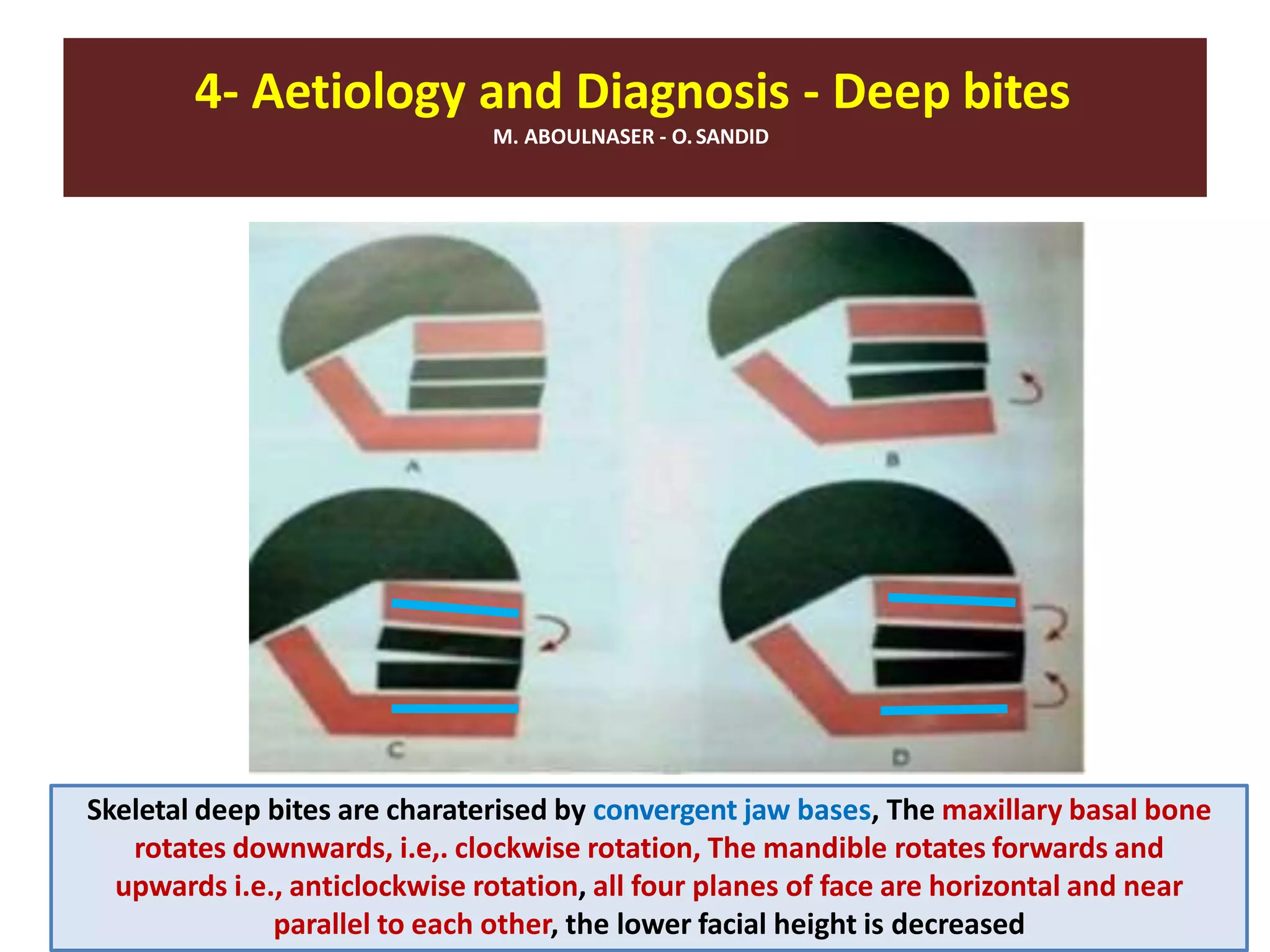 4- Aetiology and Diagnosis - Deep bites
M. ABOULNASER - O.SANDID
Skeletal deep bites are charaterised by convergent jaw bases, The maxillary basal bone
rotates downwards, i.e,. clockwise rotation, The mandible rotates forwards and
upwards i.e., anticlockwise rotation, all four planes of face are horizontal and near
parallel to each other, the lower facial height is decreased
 
