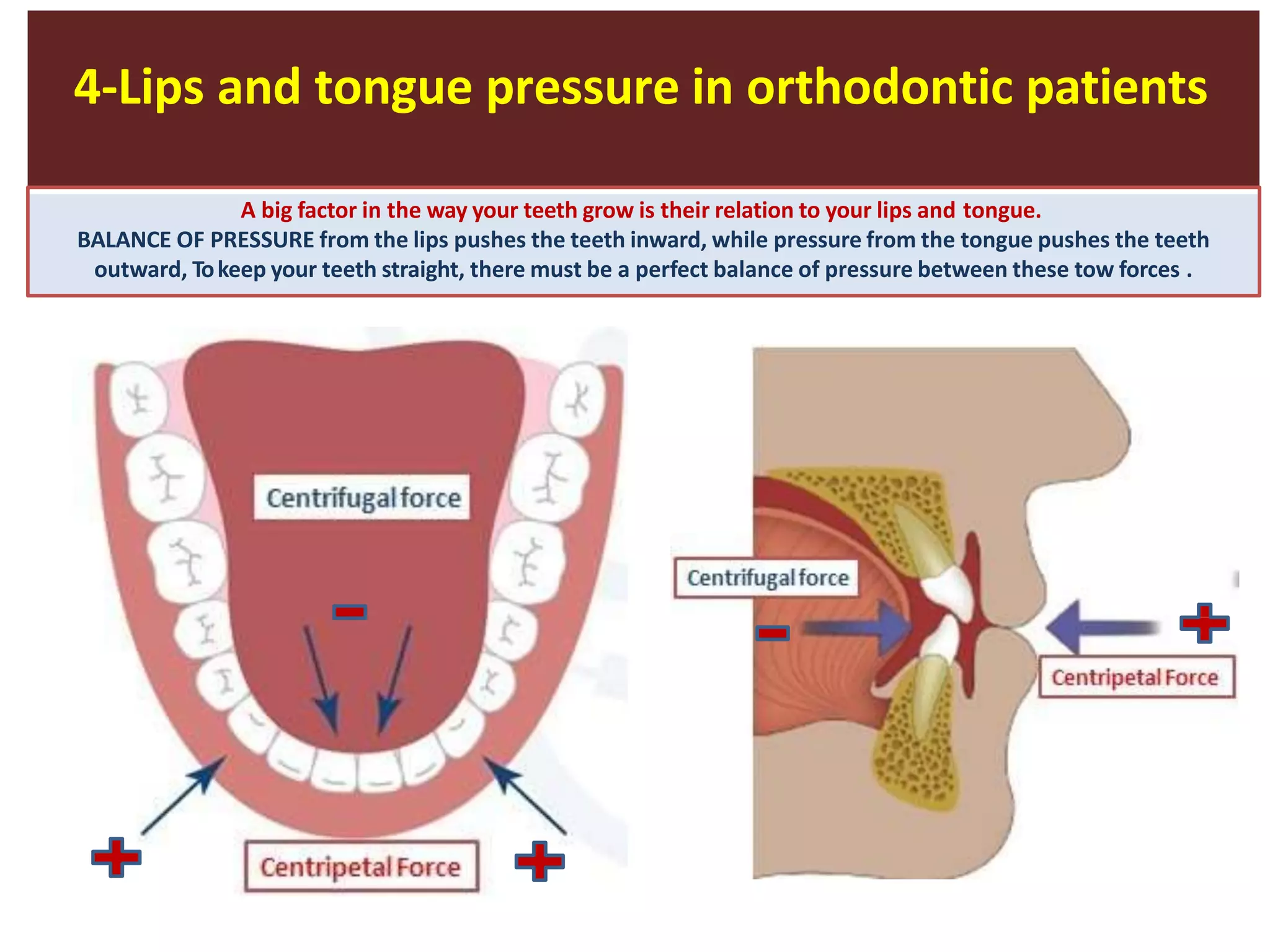 4-Lips and tongue pressure in orthodontic patients
A big factor in the way your teeth grow is their relation to your lips and tongue.
BALANCE OF PRESSURE from the lips pushes the teeth inward, while pressure from the tongue pushes the teeth
outward, Tokeep your teeth straight, there must be a perfect balance of pressure between these tow forces .
ID
ID
 