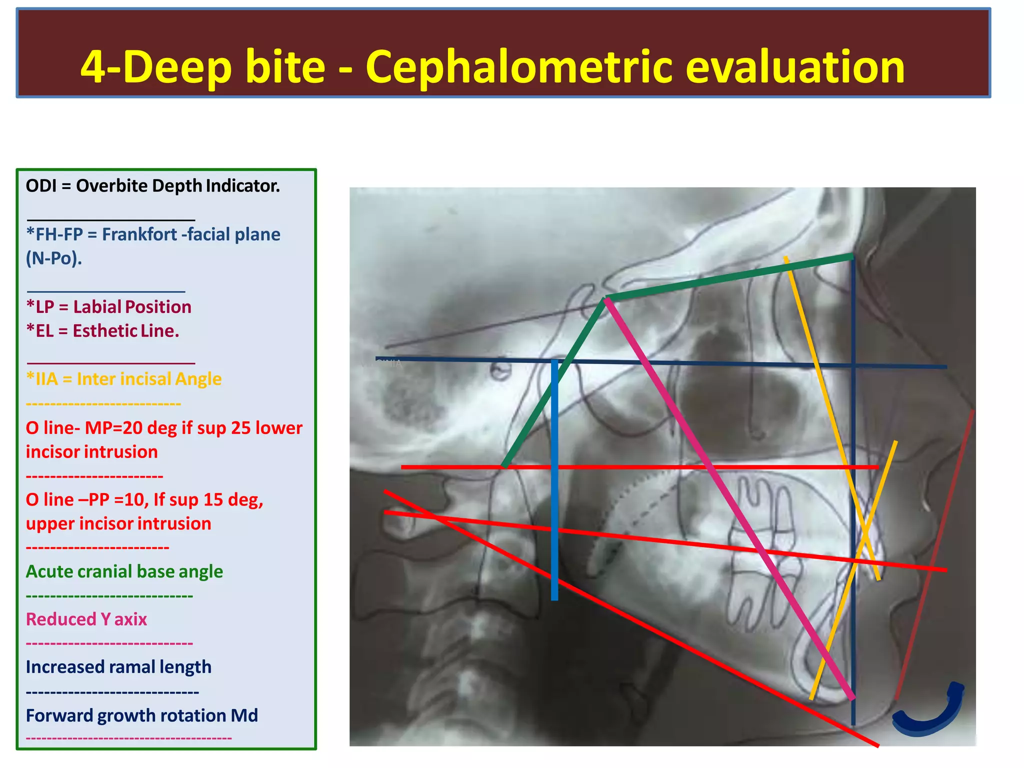 4-Deep bite - Cephalometric evaluation
ODI = Overbite DepthIndicator.
*FH-FP = Frankfort -facial plane
(N-Po).
*LP = LabialPosition
*EL = EstheticLine.
*IIA = Inter incisal Angle
--------------------------
O line- MP=20 deg if sup 25 lower
incisor intrusion
-----------------------
O line –PP =10, If sup 15 deg,
upper incisor intrusion
------------------------
Acute cranial base angle
----------------------------
Reduced Y axix
----------------------------
Increased ramal length
-----------------------------
Forward growth rotation Md
----------------------------------------
VIRGINIA
 