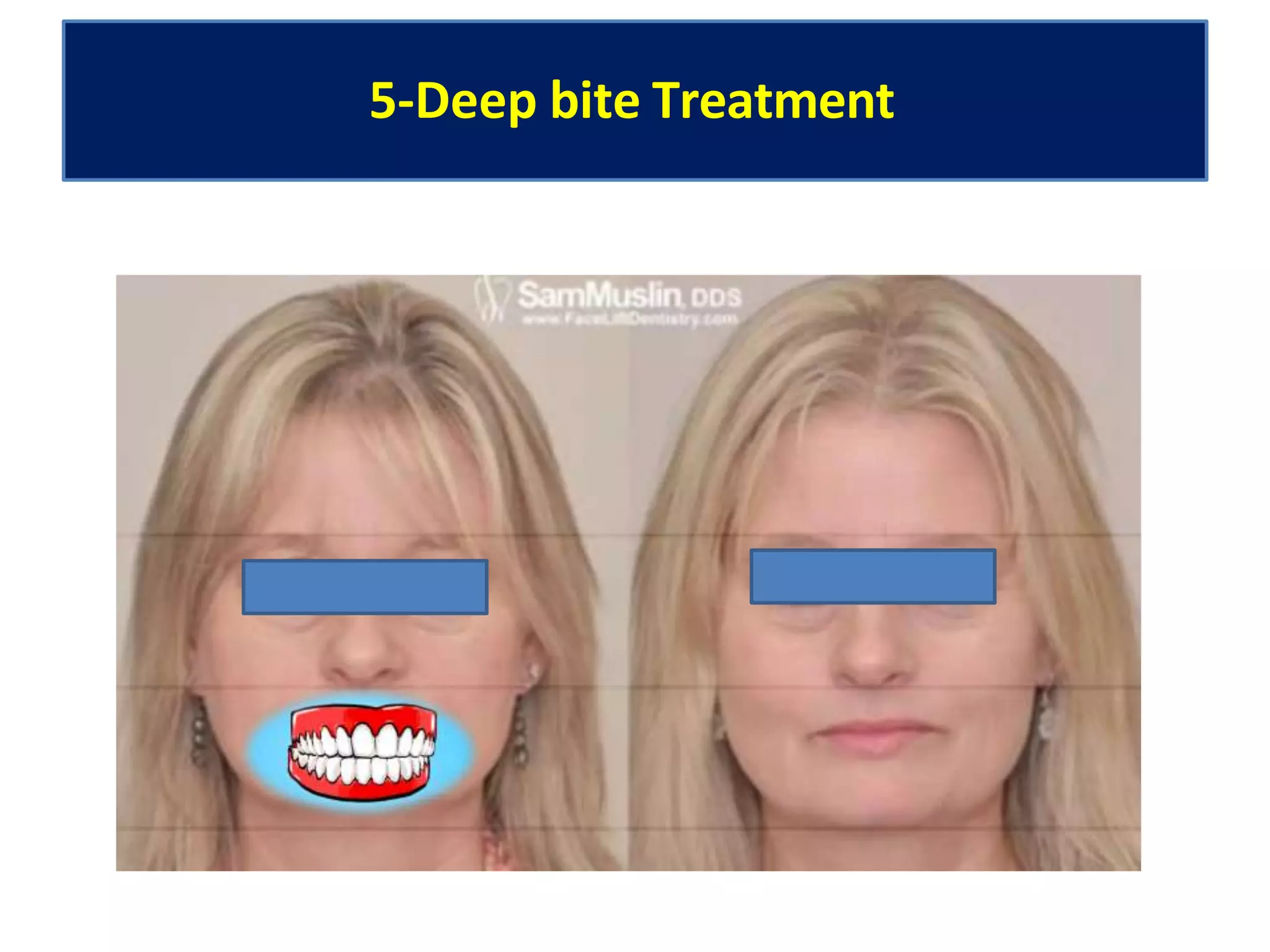 5-Deep bite Treatment
 