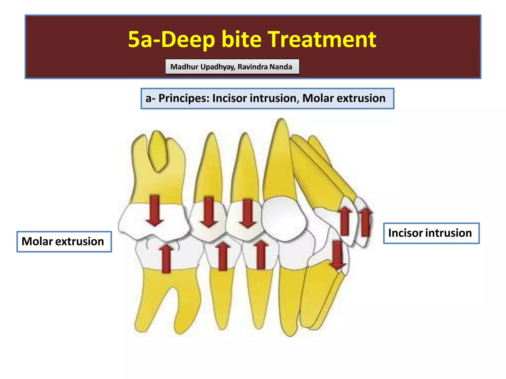5a-Deep bite Treatment
a- Principes: Incisor intrusion, Molar extrusion
Madhur Upadhyay, Ravindra Nanda
Incisor intrusion
Molar extrusion
 