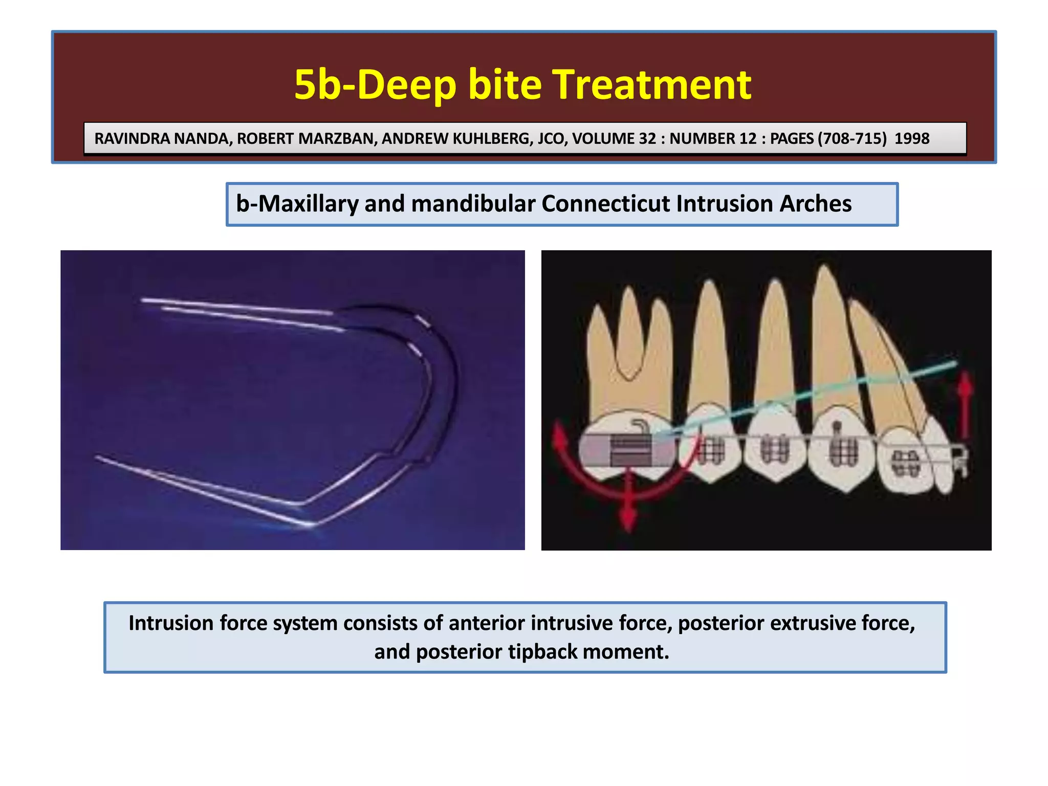 5b-Deep bite Treatment
Intrusion force system consists of anterior intrusive force, posterior extrusive force,
and posterior tipback moment.
b-Maxillary and mandibular Connecticut Intrusion Arches
RAVINDRA NANDA, ROBERT MARZBAN, ANDREW KUHLBERG, JCO, VOLUME 32 : NUMBER 12 : PAGES (708-715) 1998
 