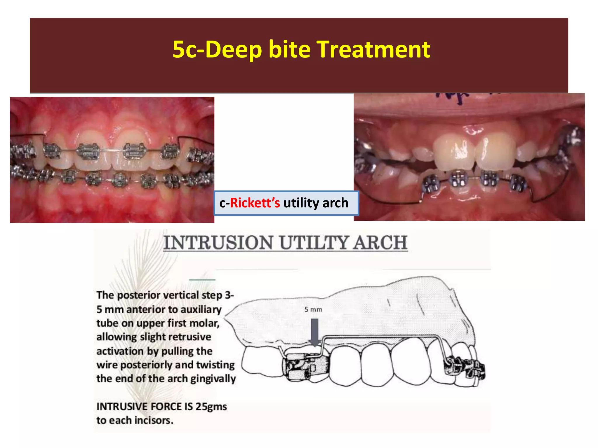 5c-Deep bite Treatment
M. ABOULNASER - O.SANDID
5c-Deep bite Treatment
c-Rickett’s utility arch
 