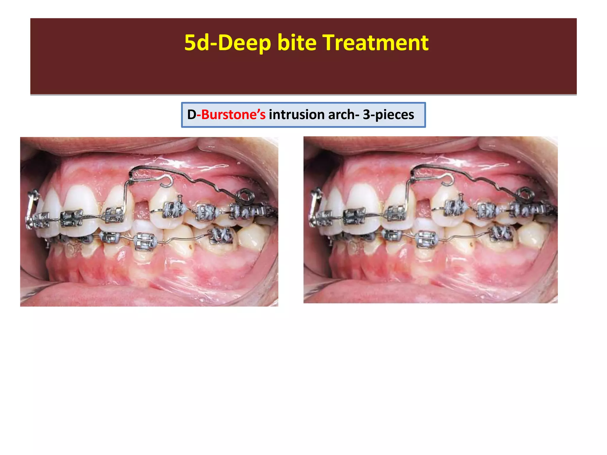 5d-Deep bite Treatment5d-Deep bite Treatment
D-Burstone’s intrusion arch- 3-pieces
 