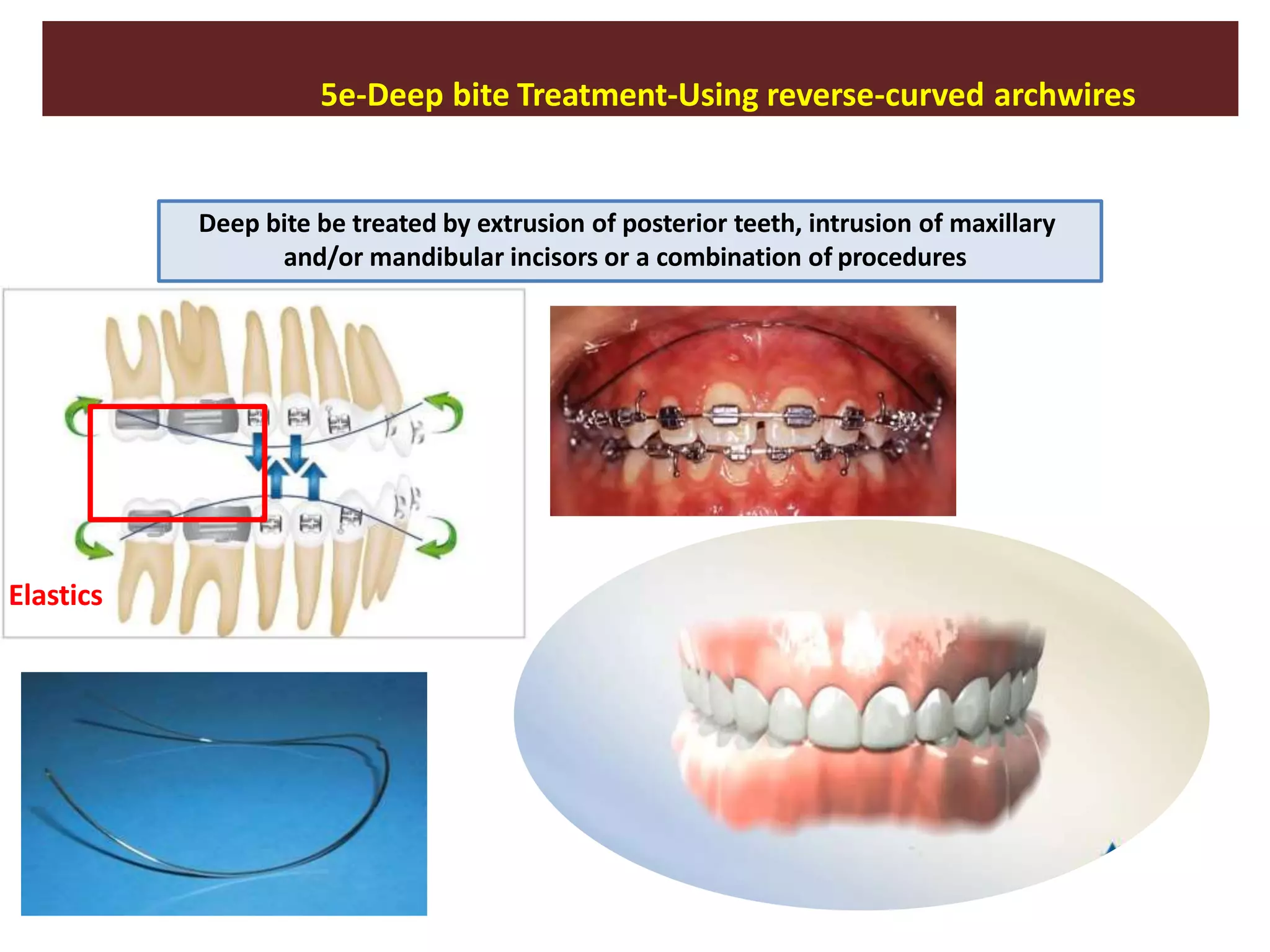 5e-Deep bite Treatment-Using reverse-curved archwires
Deep bite be treated by extrusion of posterior teeth, intrusion of maxillary
and/or mandibular incisors or a combination of procedures
Elastics
 