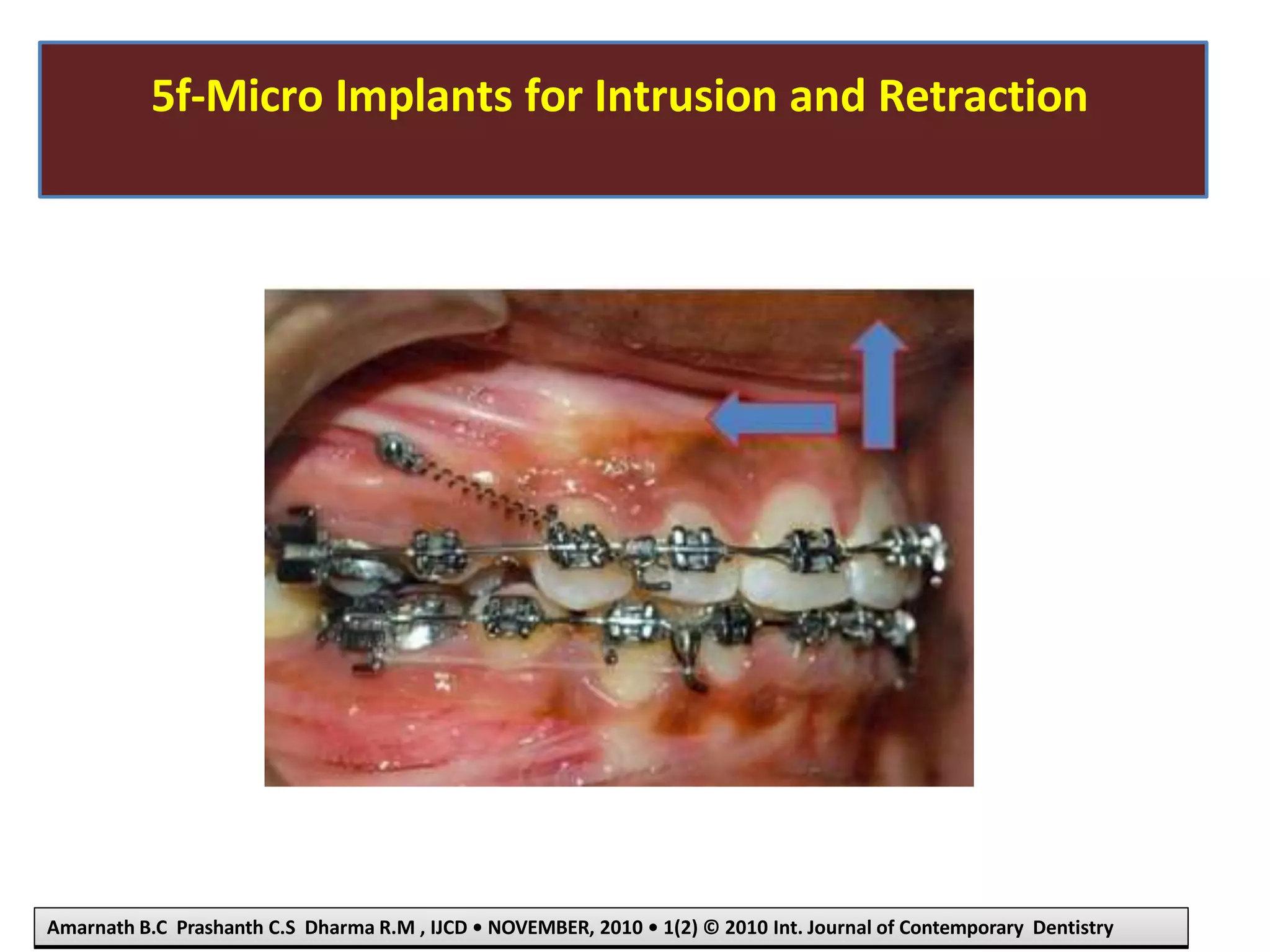 5f-Micro Implants for Intrusion and Retraction
Amarnath B.C Prashanth C.S Dharma R.M , IJCD • NOVEMBER, 2010 • 1(2) © 2010 Int. Journal of Contemporary Dentistry
 